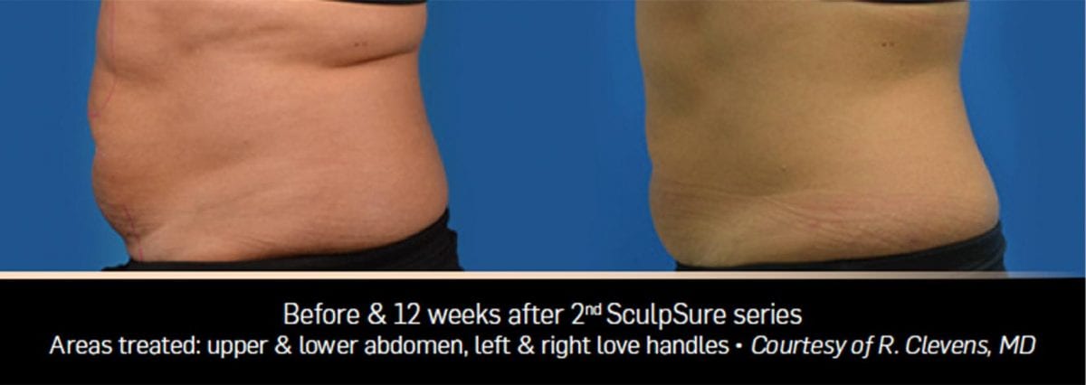 Sculpsure Before and After